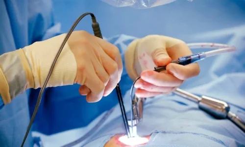 Advanced Laser Treatment for Piles in Ahmedabad